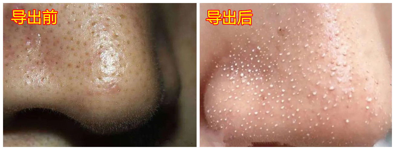 毛孔堵塞毛孔发黑怎样清理,毛孔长螨虫堵塞毛孔怎么办