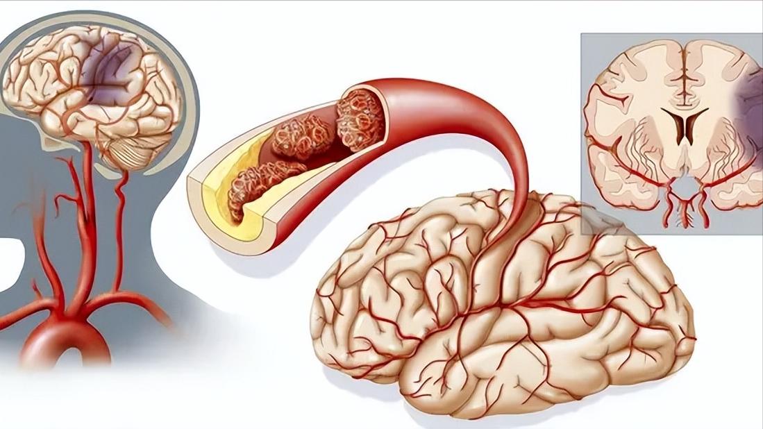 几块钱一瓶的维生素B6有助改善睡眠、预防脑梗，科学服用注意4点