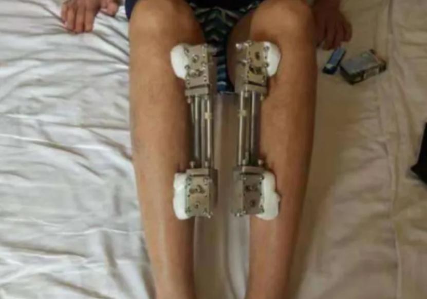 李亚诺中国断骨增高第一人,当年花16万断腿增高