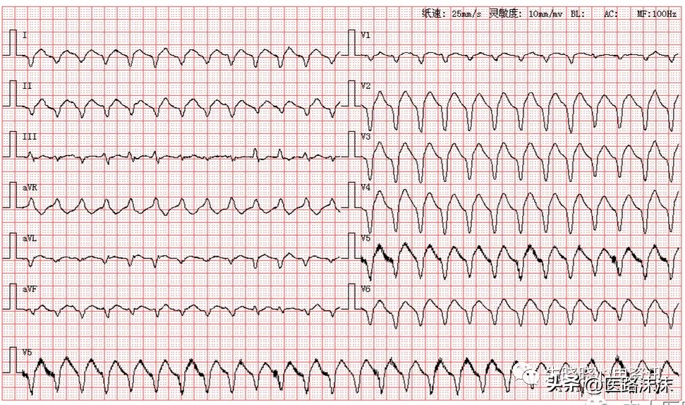 心动过速恢复方法,心动过速吃什么药
