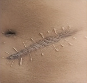 最难愈合的疤痕,无法治愈的疤痕