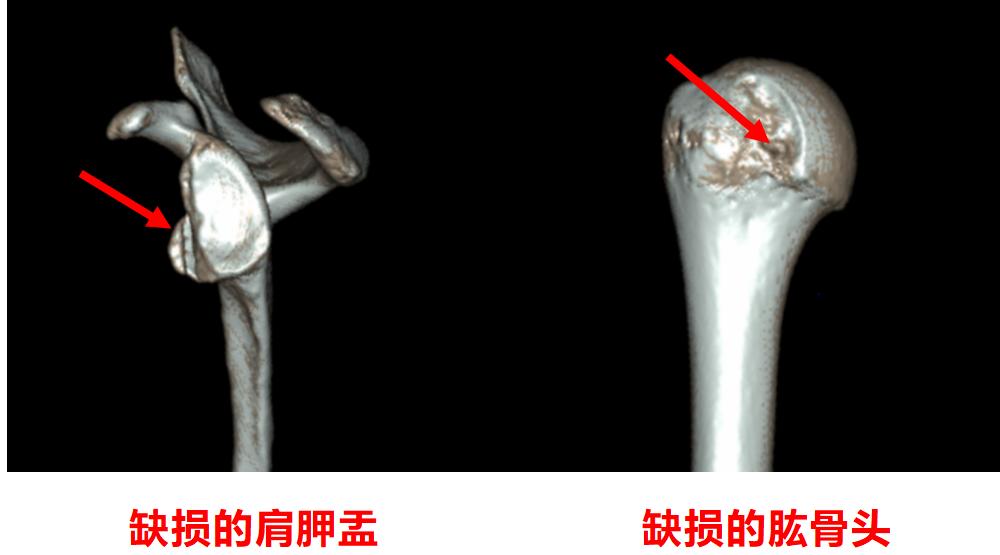 肩膀像脱臼又不像脱臼是怎么回事,肩膀脱臼之后还是容易脱臼