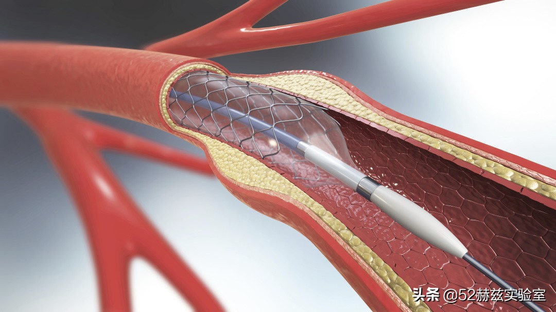 从13000元骤降至700元！看国产心脏支架如何吊打国外？
