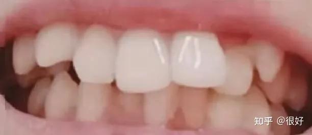 整牙日记大全,整牙日记大全100字