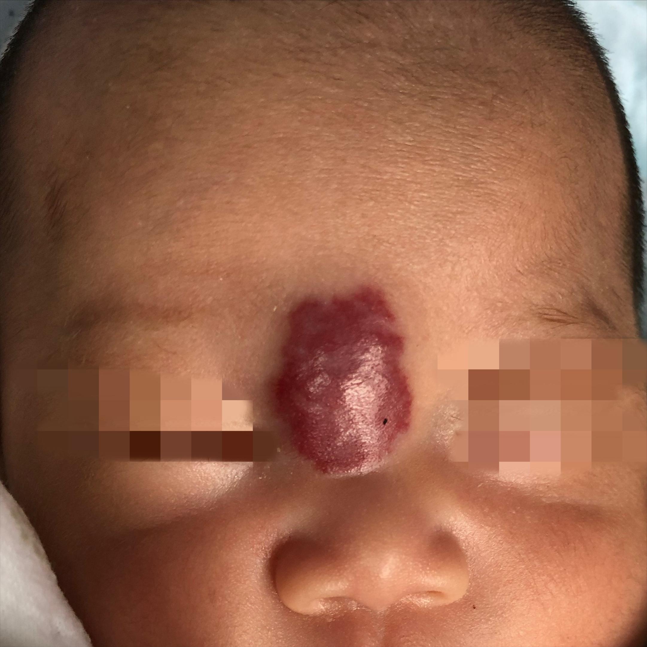 鼻中隔血管瘤不治疗可以吗,肾血管瘤不治疗可以吗