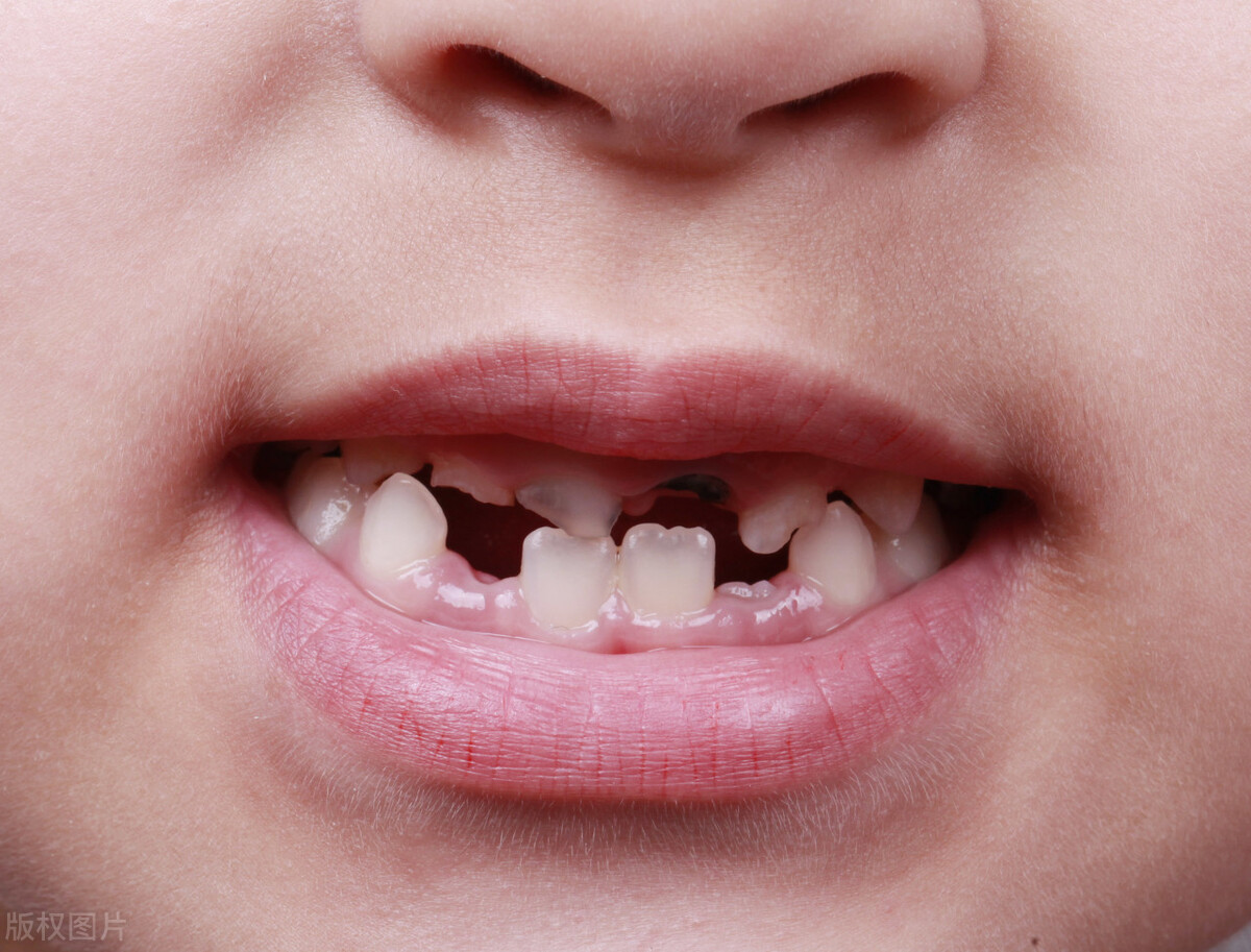 龋齿的危害是什么？蛀牙不治疗会怎样？口腔专家告诉你