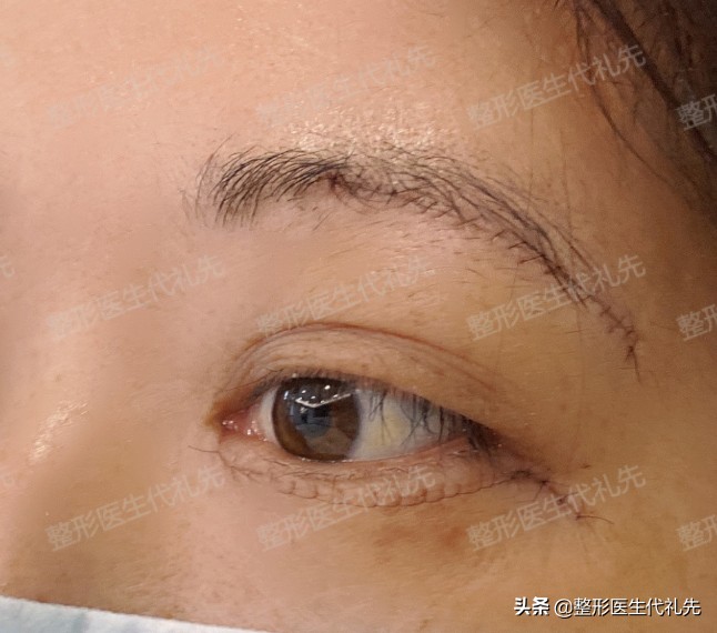 脂肪型眼袋伴有泪沟怎么办,眶隔脂肪释放去眼袋是怎么回事