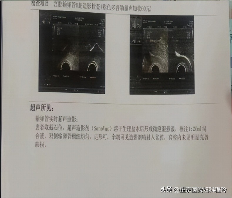 宫外孕微创手术后输卵管还能用吗,什么情况下宫外孕需要切除输卵管