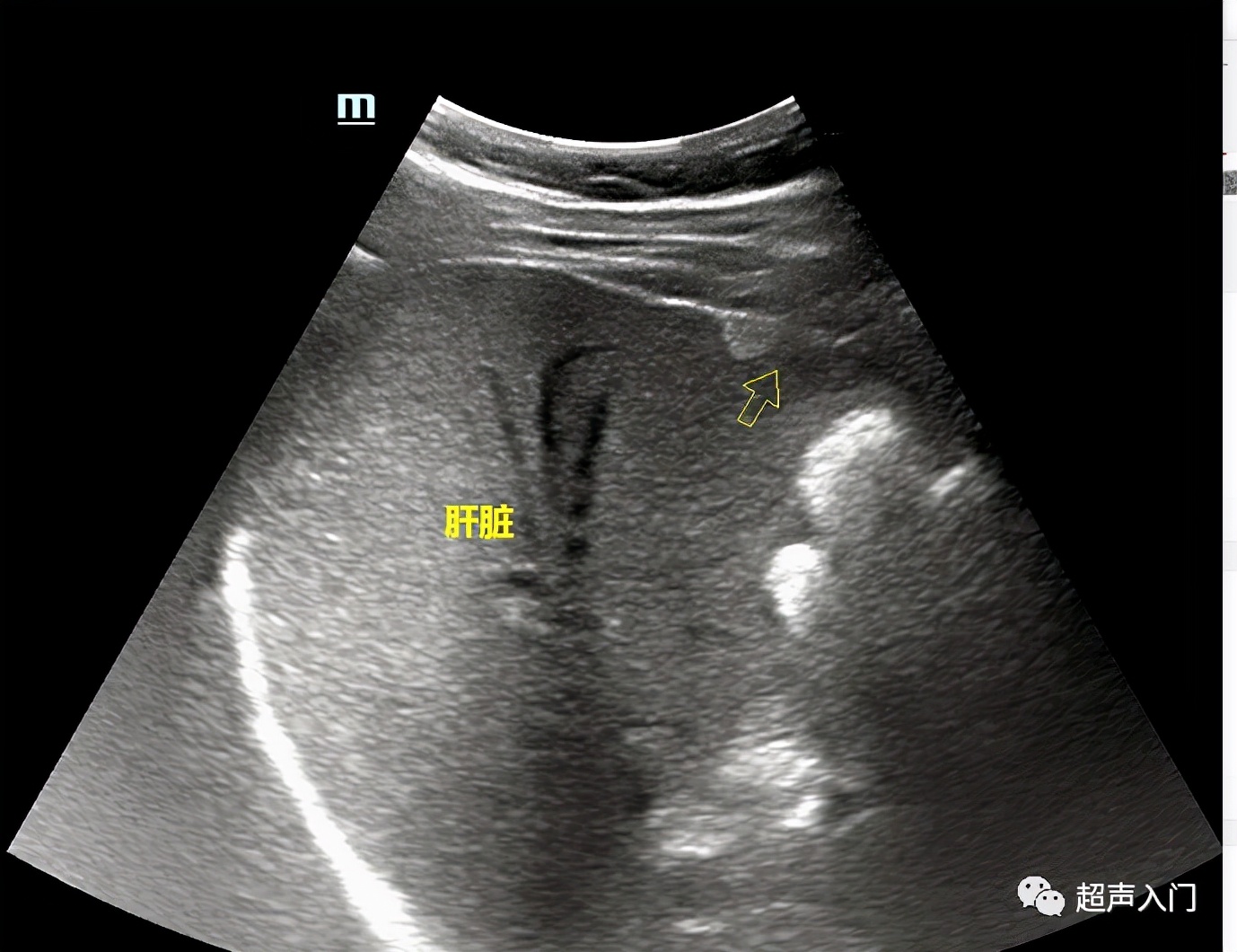 超声学自己能学吗,超声初学者有何窍门