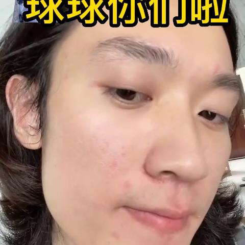 油皮黑头闭口清理方法,油皮去黑头闭口粉刺