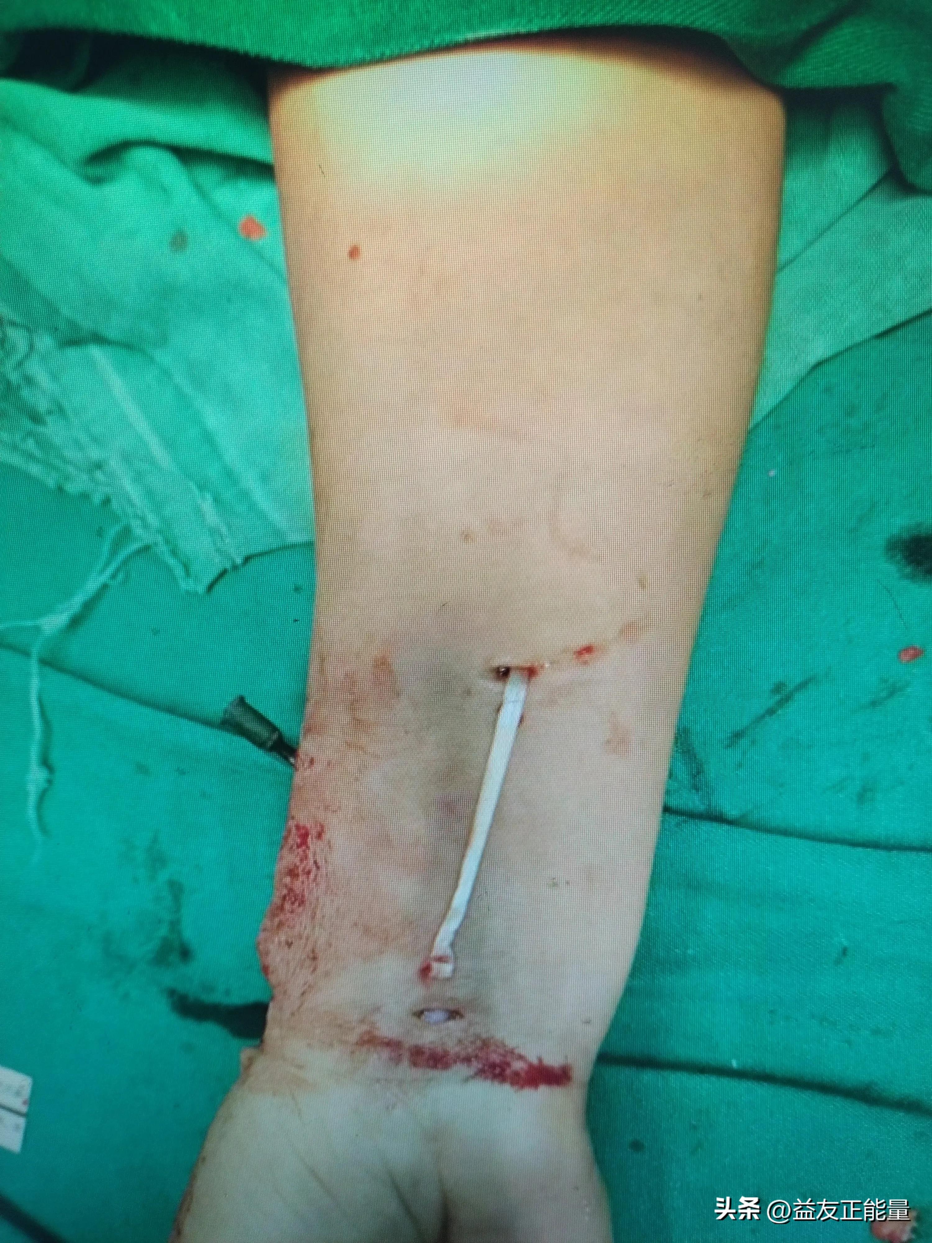 患者去民营医院包扎,被诱进手术室给做了手术,医生说断了二根筋