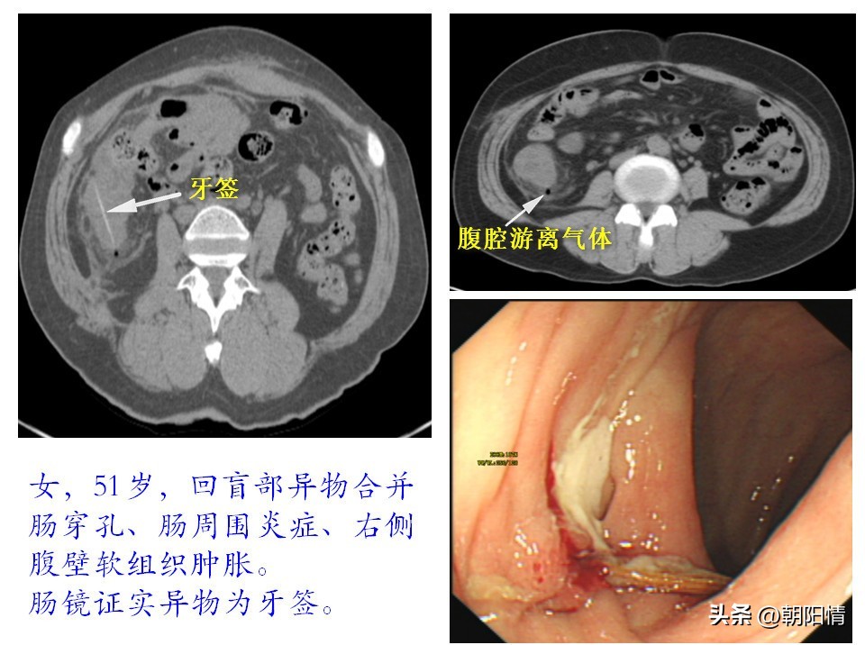 消化道异物中医诊断名称,消化道骨性异物