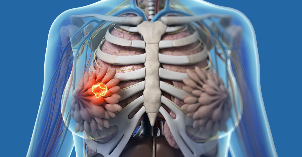 乳房三类增生结节,乳腺二级增生怎么办