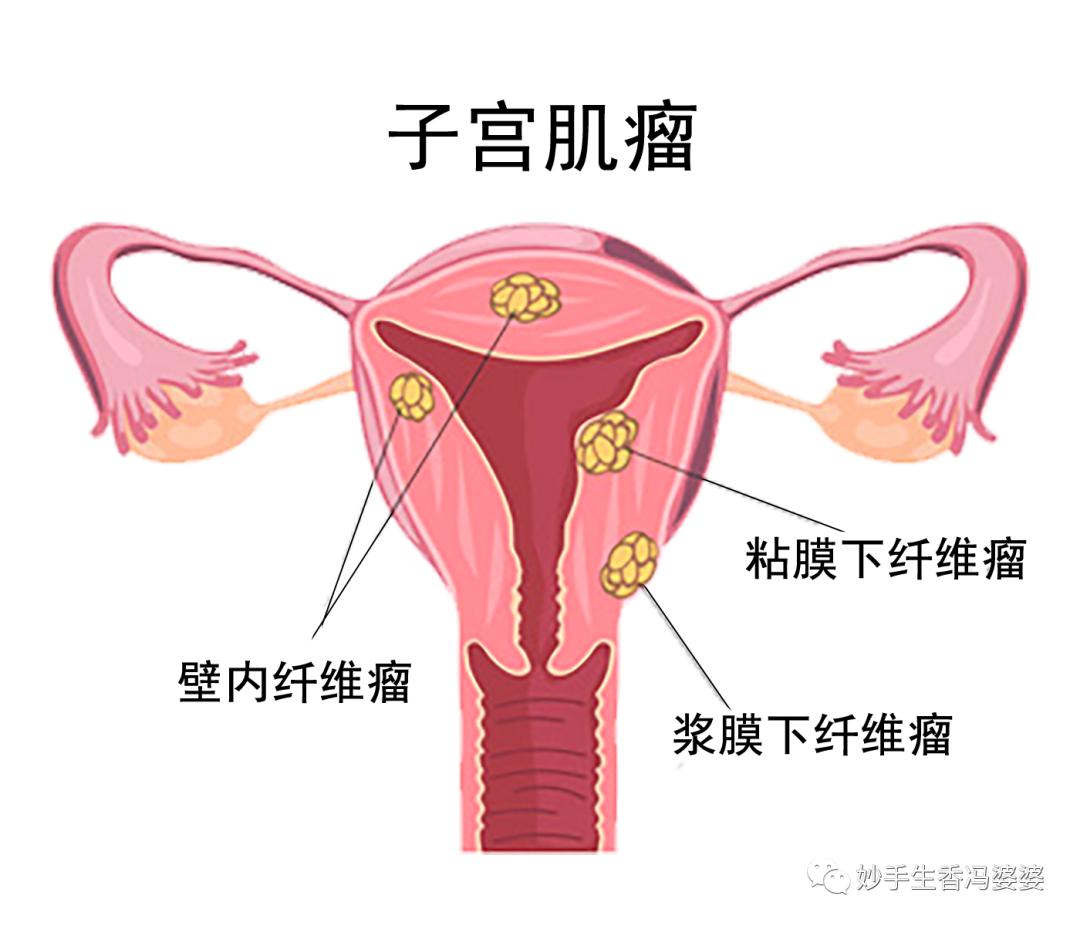 输卵管一边堵了一边切了怎么办,输卵管明明通了为啥又堵了