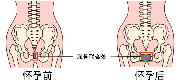 到底骨盆修复有必要做吗,骨盆修复到底有必要吗