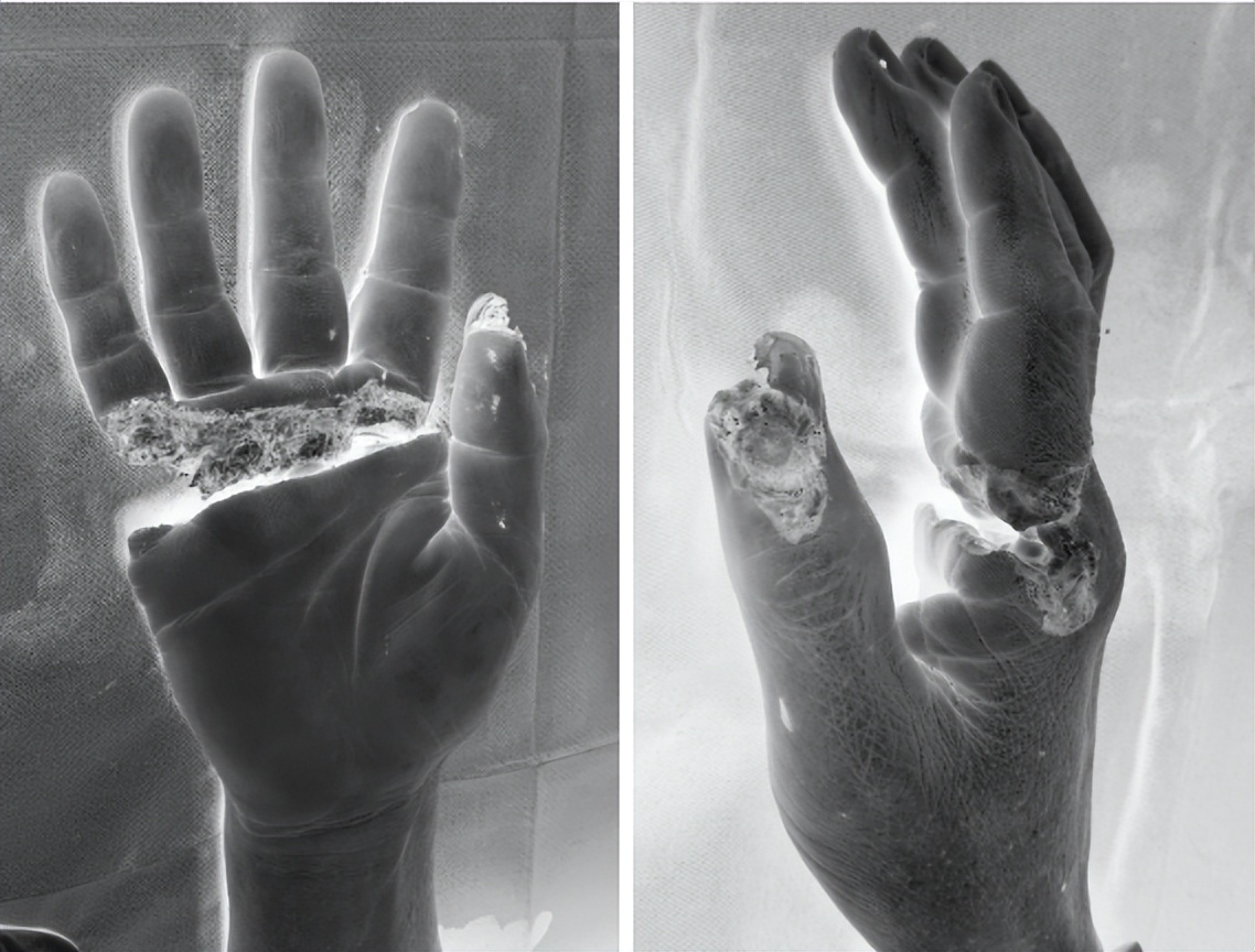 男子右臂意外截肢完整版,男子断指再植