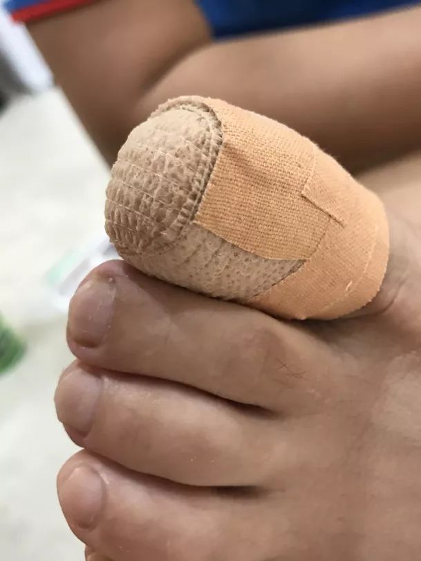 灰指甲到底怎么才能彻底治好,灰指甲怎么治最好的偏方大全