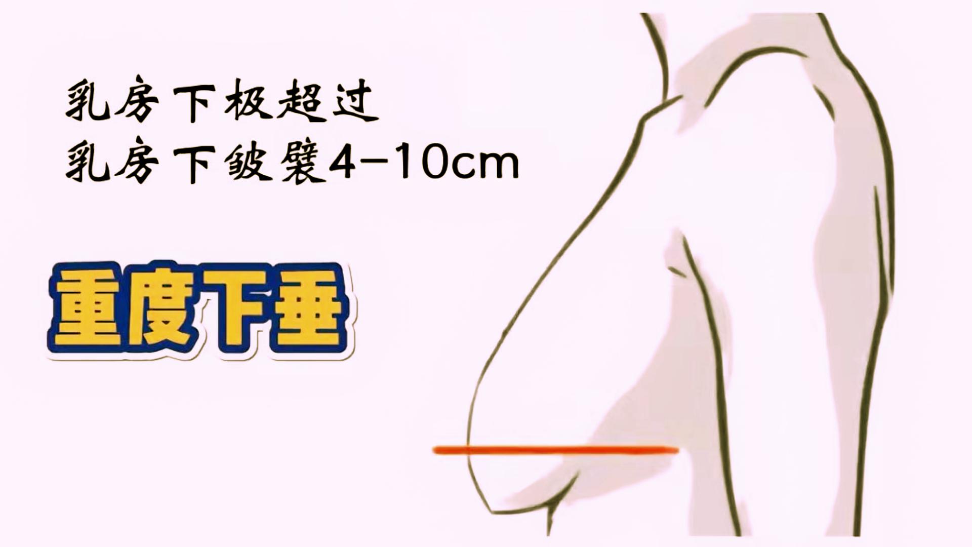 女人胸部下垂大小不一是什么问题,23岁胸部有一点下垂应该怎么办