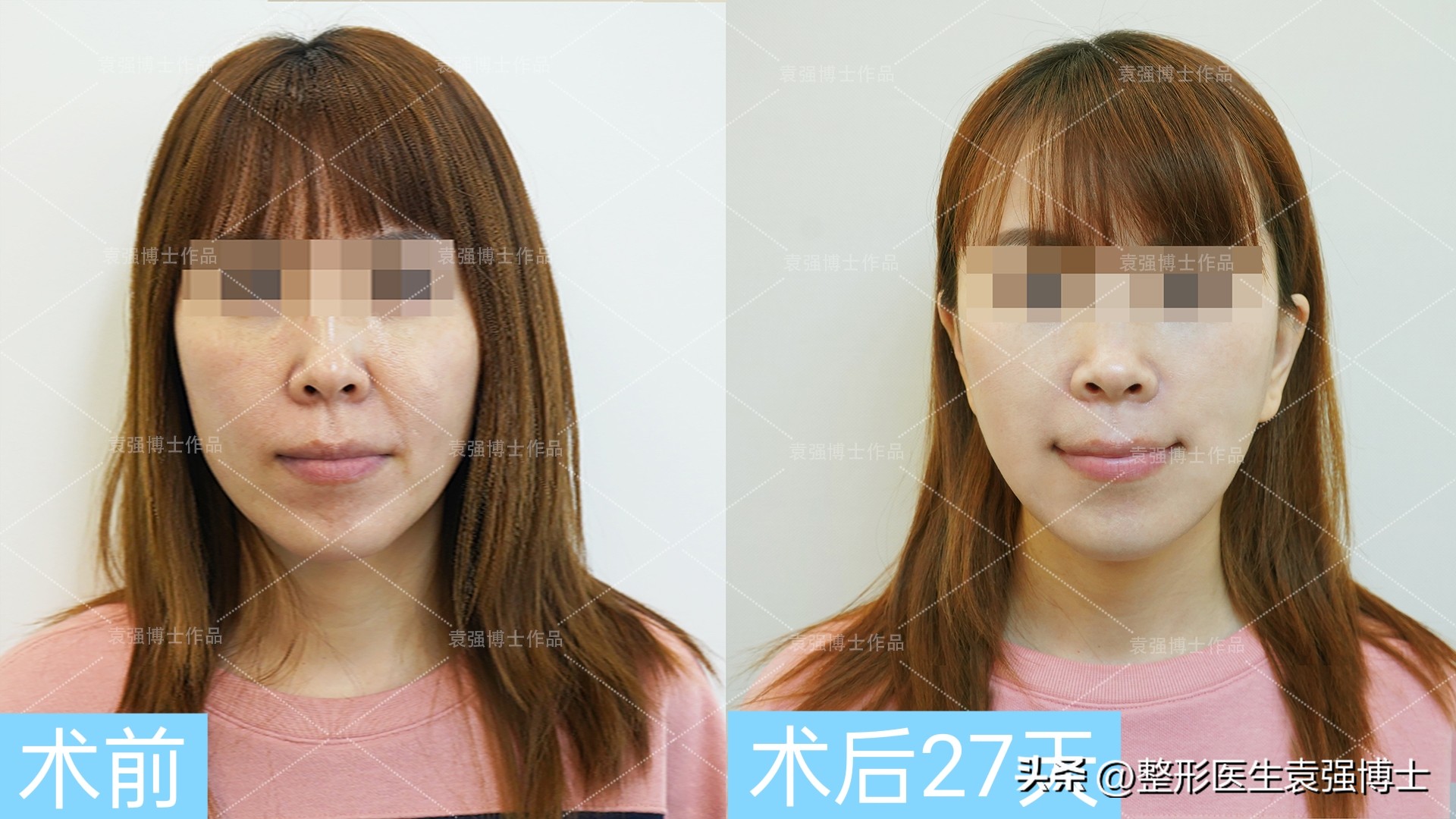 法令纹重就丑吗,法令纹丑了怎么办