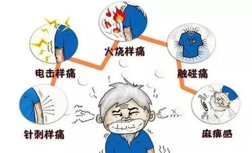 疼起来真要命的带状疱疹,有一种痛叫带状疱疹疼