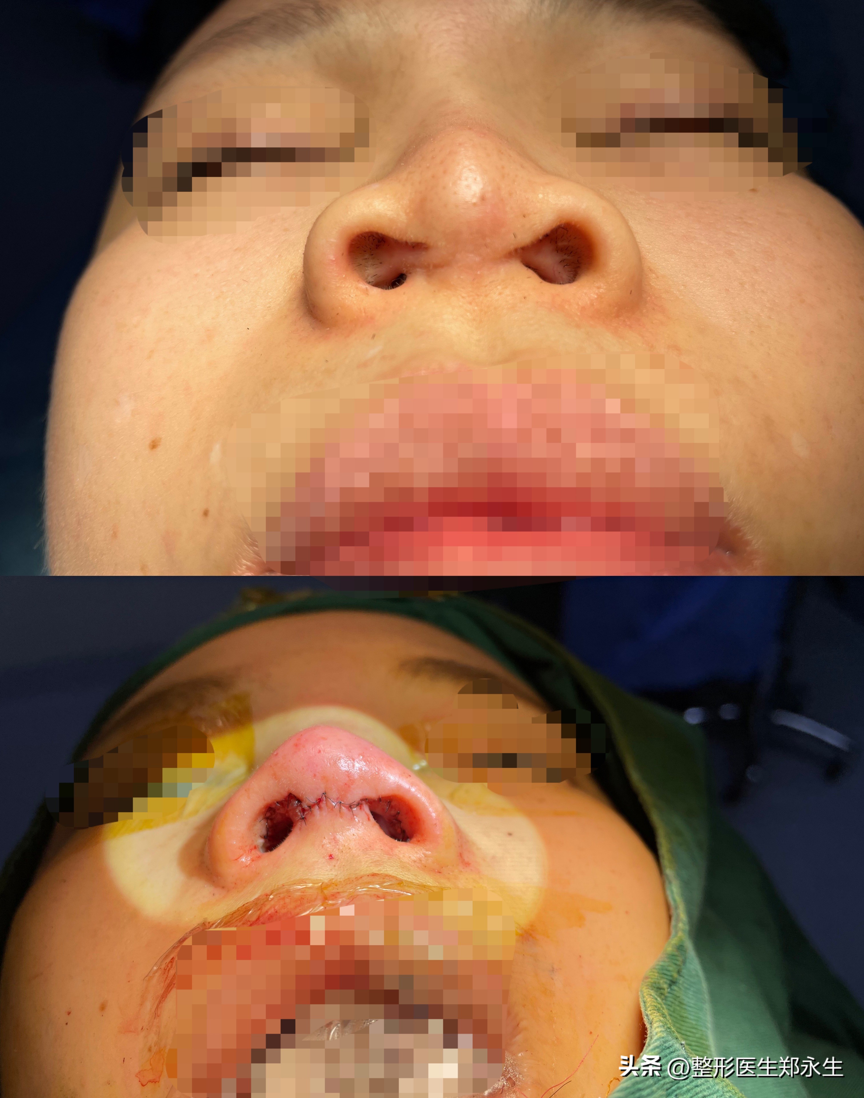 女子花7000去美容不料整成红鼻子,美容整鼻子事件