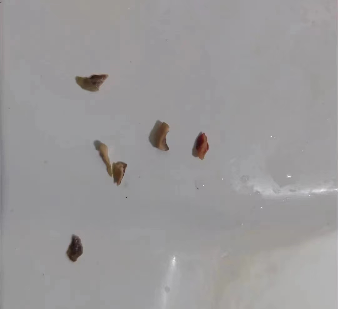 怎样治疗牙结石用简单的方法,牙结石的治疗全过程