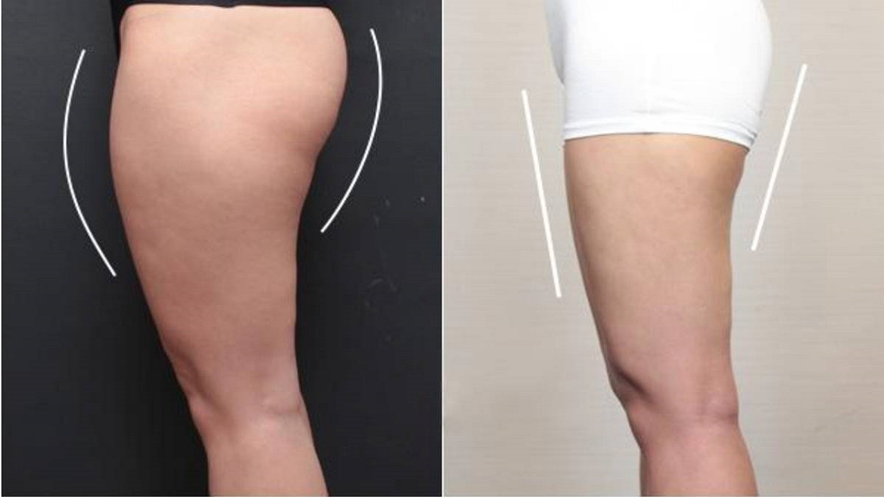 腿变细是预示身体什么病,腿型对腿粗细的影响