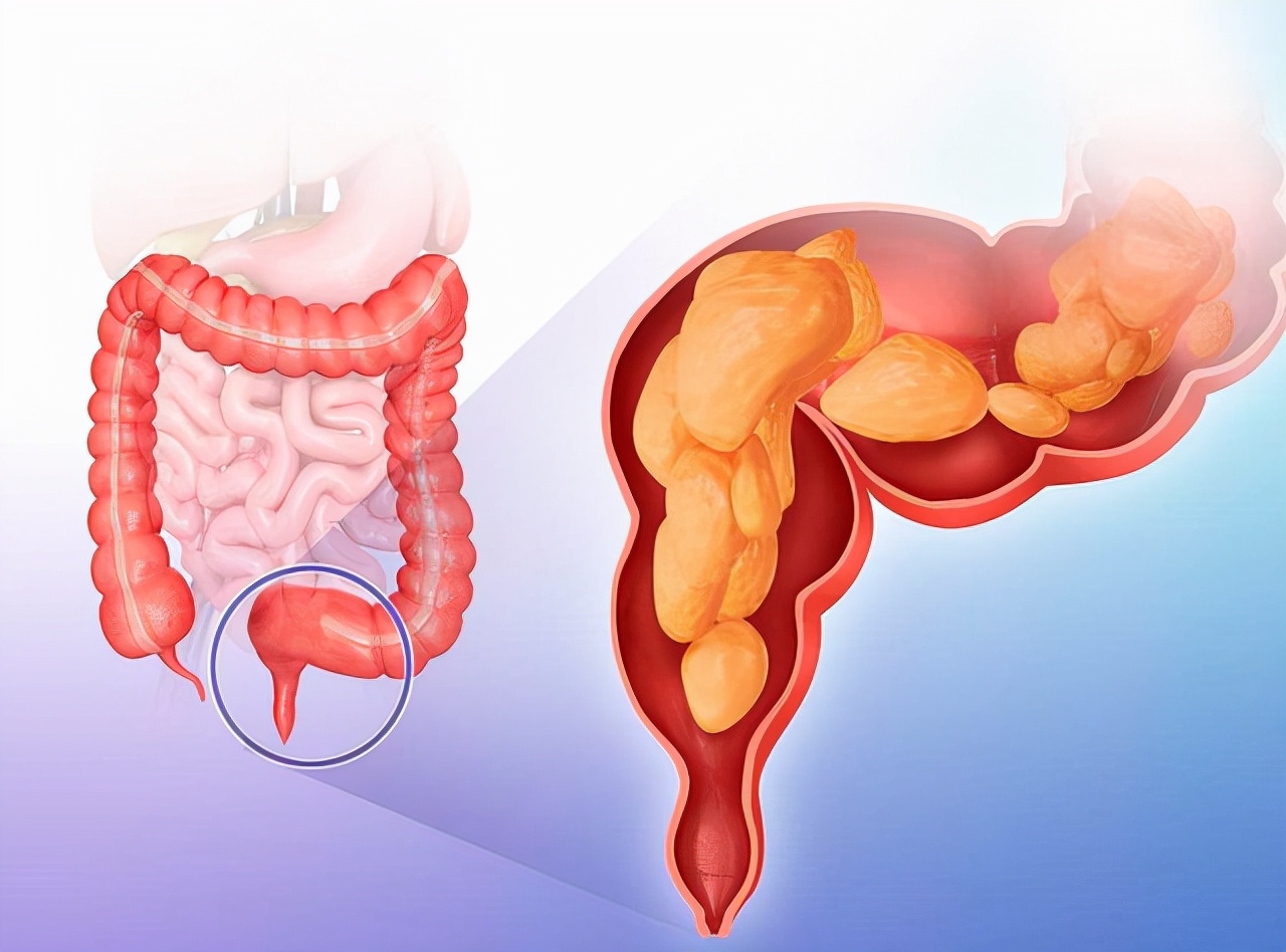 人如果没了“肛门”会怎样？什么情况下，会被切除“肛门”？