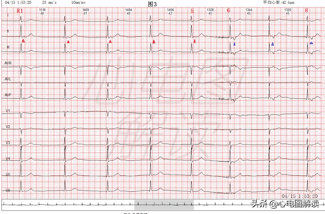 交界性逸搏心律伴窦性心动过缓,交界性逸搏是交界性心动过速吗