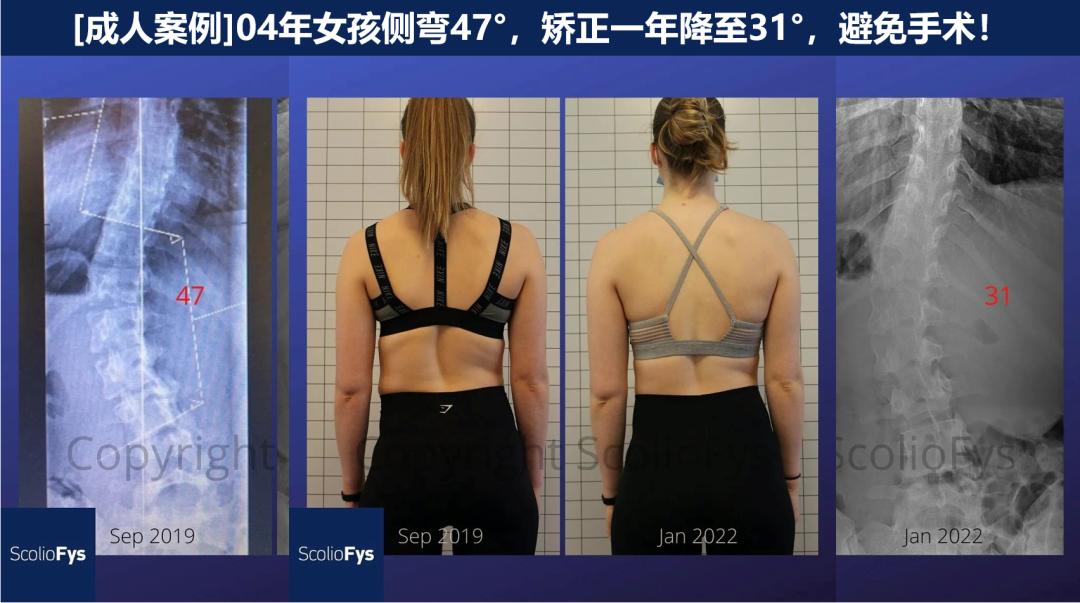 成人脊柱侧弯往哪弯,成年人脊柱侧弯怎么矫正