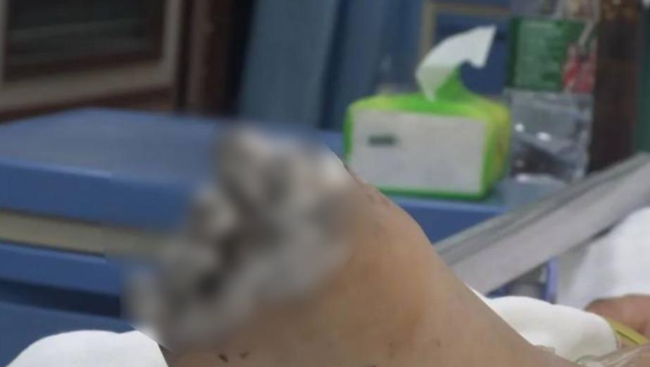 女孩iphone充电被电击面临截肢,iphone边充边玩被电击