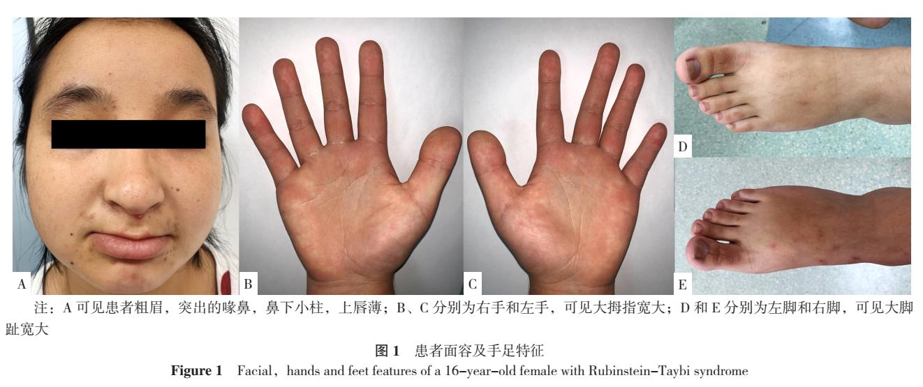 鲁宾斯坦泰比综合征的治疗方法,鲁宾斯坦泰比综合征是罕见病吗