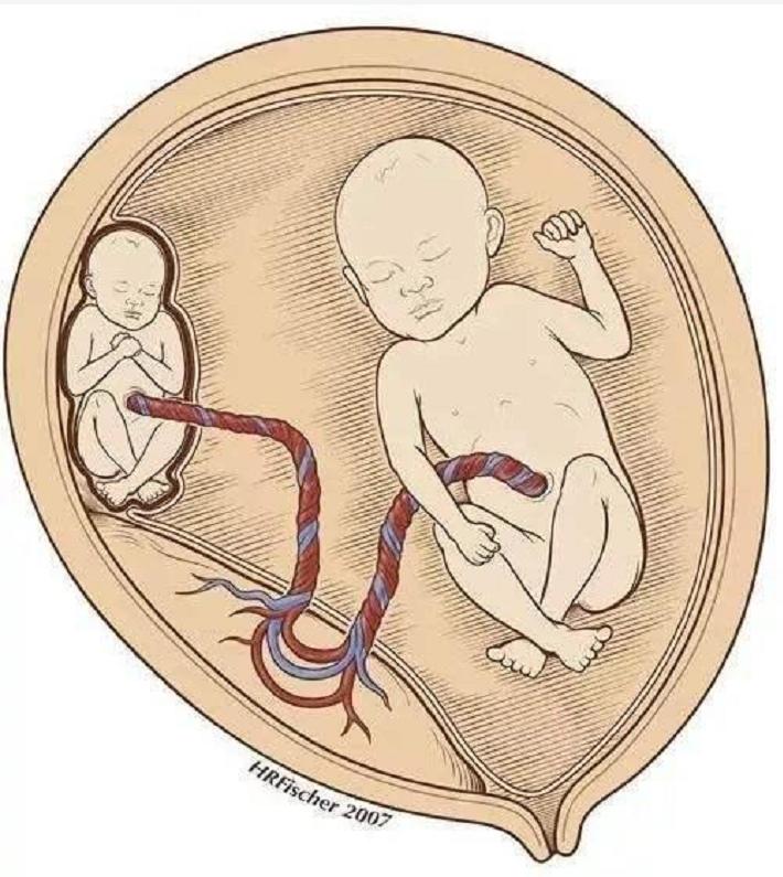 印度小伙意外怀孕,印度男子腹中神秘生物