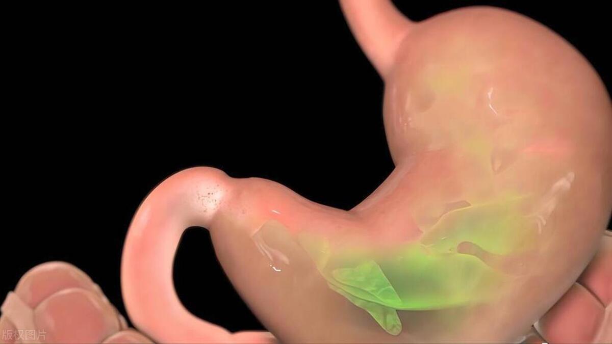 胃酸过多胃酸反流烧心,胃酸过多烧心食道反流应注意什么