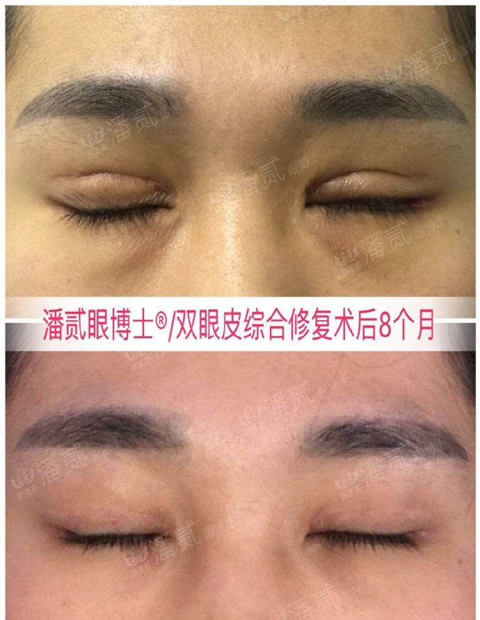 埋线双眼皮如果不满意怎么修复,切开双眼皮失败可以用埋线修复吗