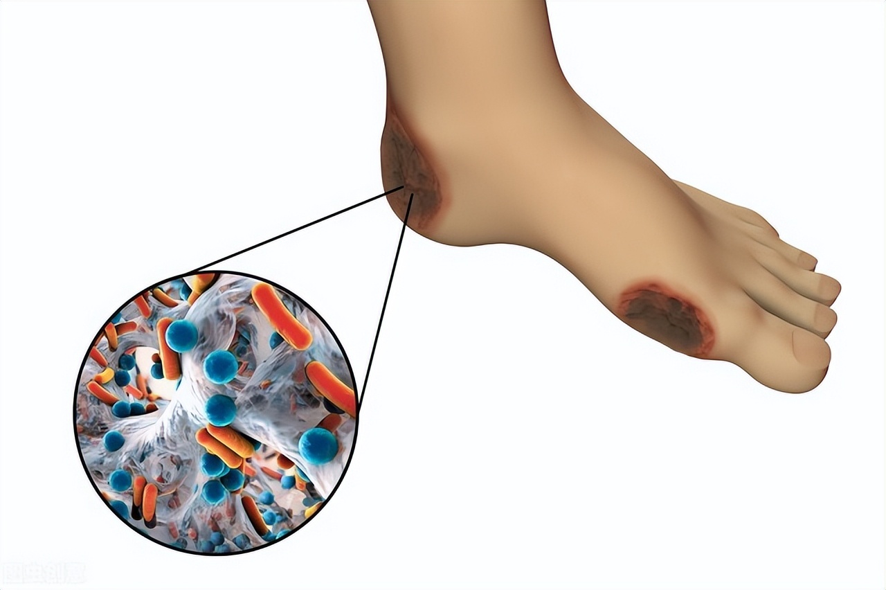血栓引起的脚趾头坏死,脉管炎脚趾头坏死化脓