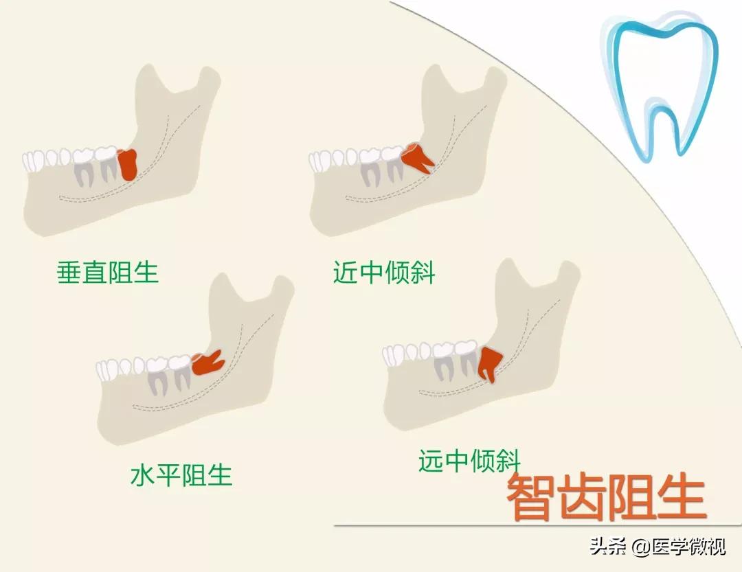拔智齿是硬把牙拽下来吗,拔智齿到底要不要拔掉