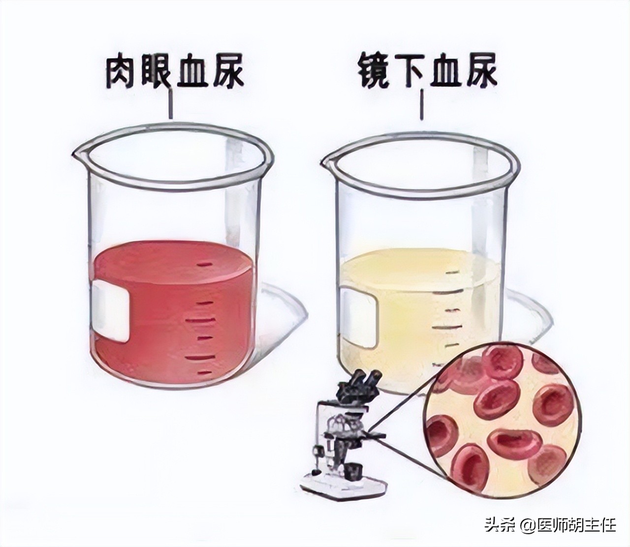 体检查出有肾结石要注意什么,体检检查出肾结石怎么处理