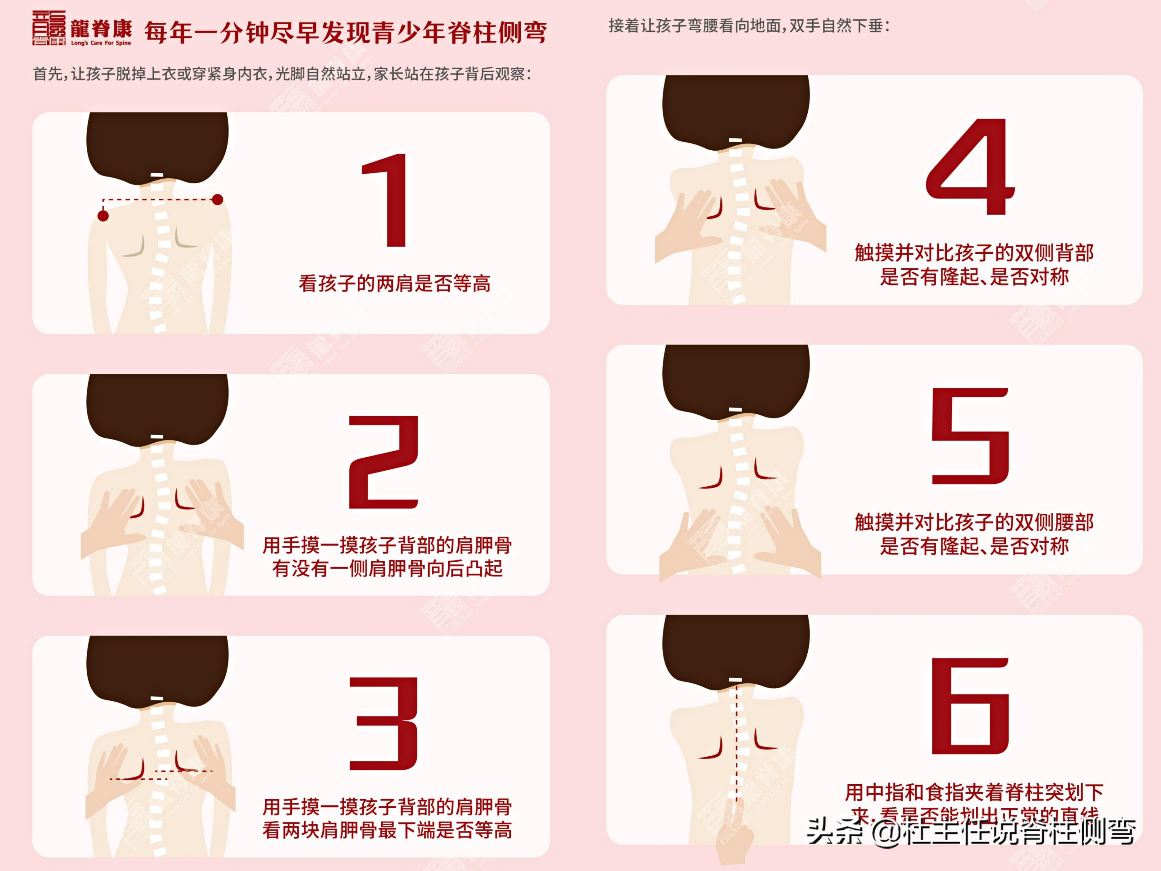 11至14岁青少年更易患脊柱侧弯,脊柱侧弯多少度会出现剃刀背
