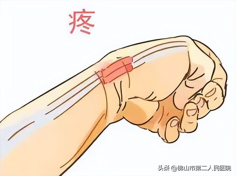 弹响指小针刀治疗演示图,弹响指做针灸能彻底根治吗