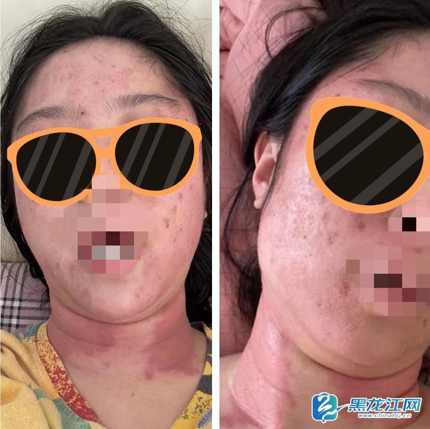 做美容花费6万的事件,做美容过敏多久能自愈