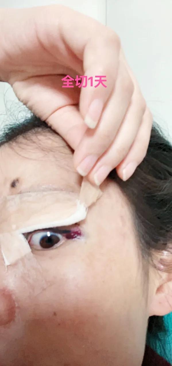 做双眼皮恢复期间能吃红糖吗,恢复最快的双眼皮