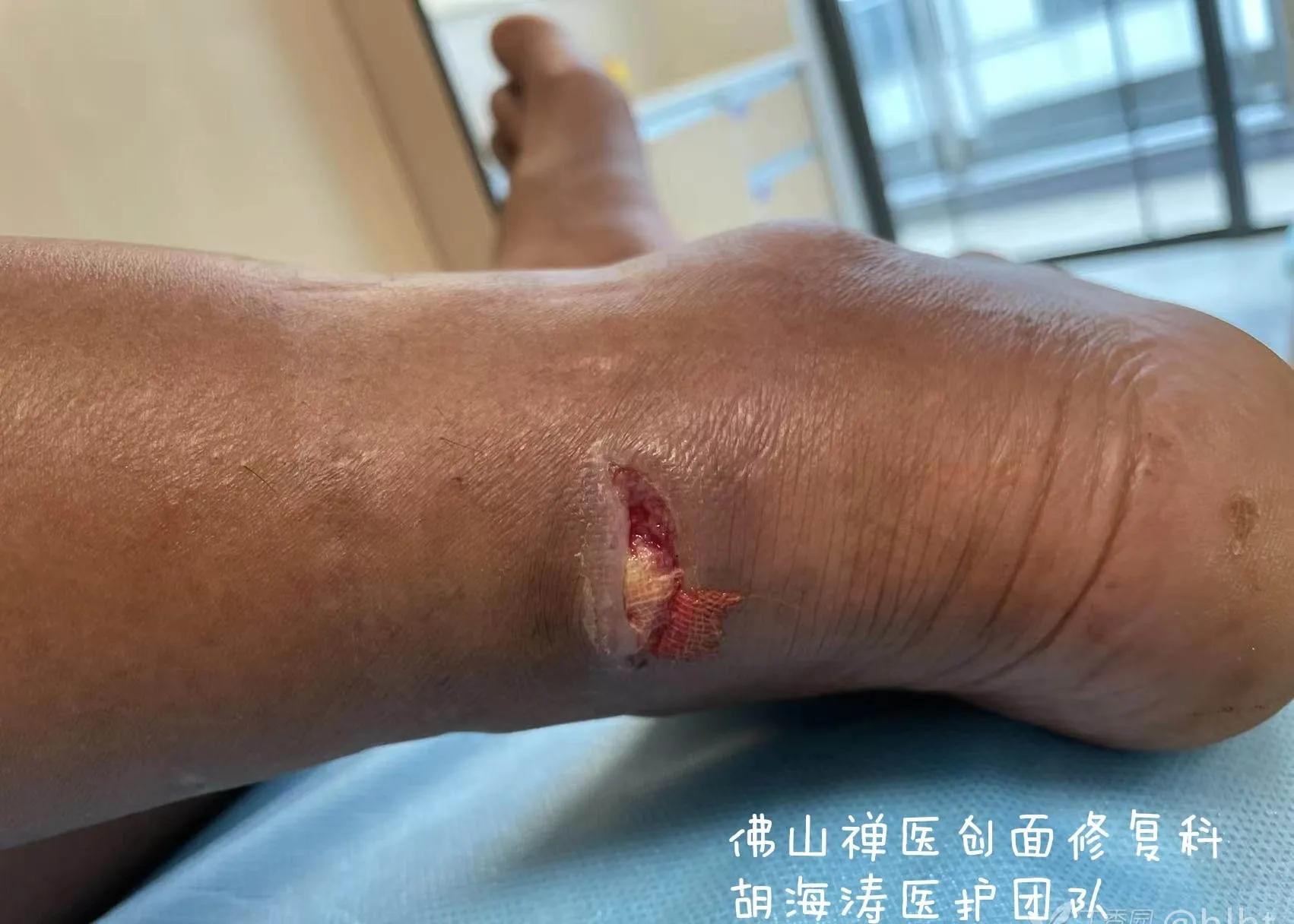 农民工受伤没有钱做手术,农民工受伤不处理会怎样