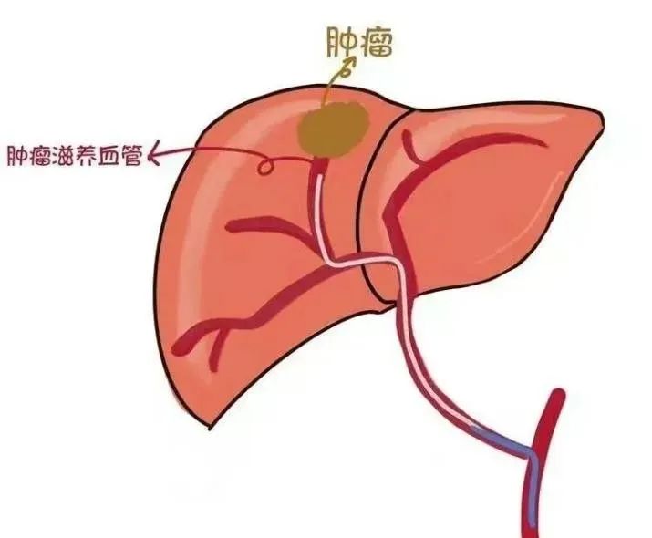 肝动脉灌注化疗治疗肝癌的并发症,肝癌肝动脉栓塞化疗