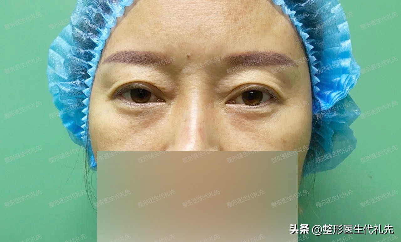 五十岁割双眼皮祛眼袋,40岁小眼睛全切双眼皮效果