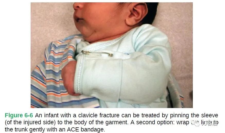 儿童锁骨骨折保守治疗的弊端,锁骨粉碎骨折错位不处理会愈合吗