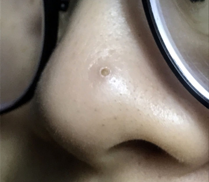 20年的黑头有多大,世界上最长的黑头到底有多长