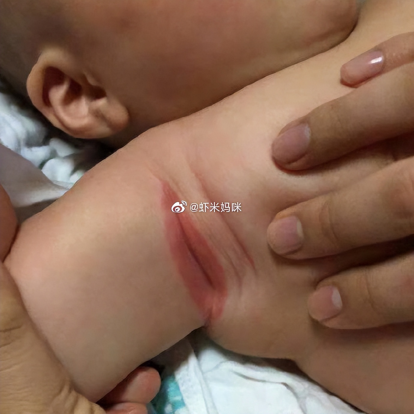 皮肤褶皱的地方出红疹子能擦粉吗,皮肤褶皱多是怎么回事