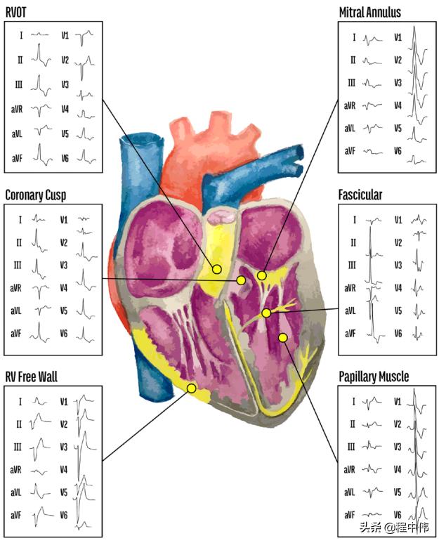 室性早搏鉴别诊断及治疗,心脏室性早搏怎么治