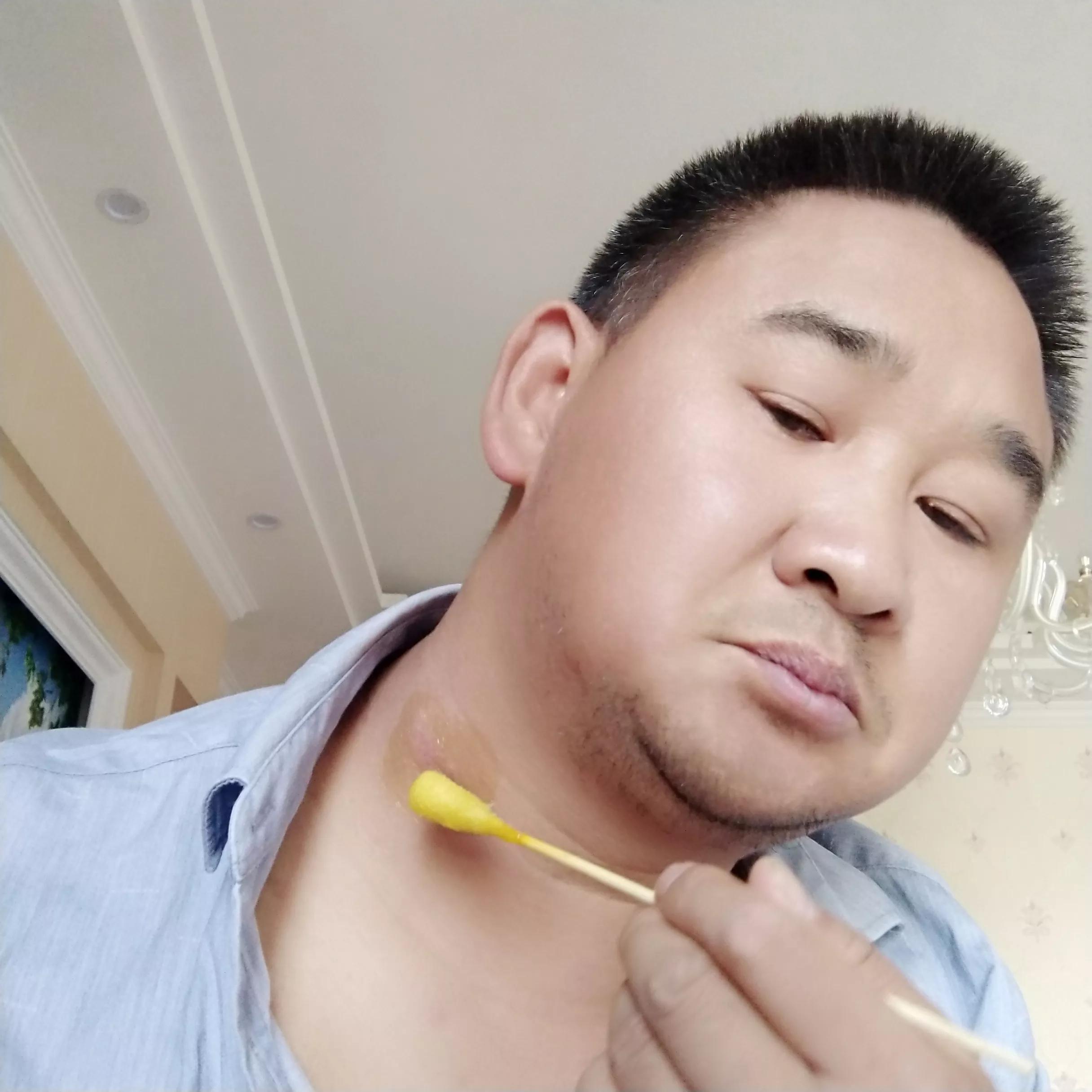 牛皮癣伴随一生是怎么样的体验,对抗牛皮癣一直在坚持